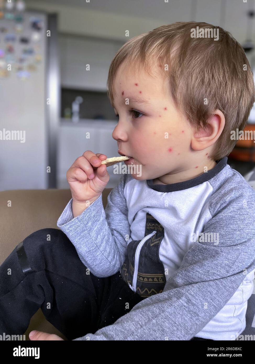 Ritratto del bambino piccolo con la varicella che mangia i biscotti Foto Stock