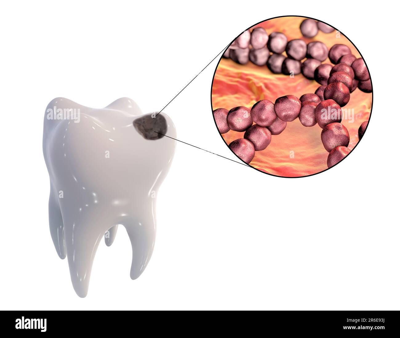 Carie dentali. Illustrazione di un dente con cavità e vista ravvicinata dei batteri che causano la formazione di carie. Foto Stock