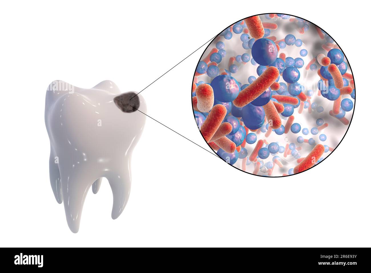 Carie dentali. Illustrazione di un dente con cavità e vista ravvicinata dei batteri che causano la formazione di carie. Foto Stock