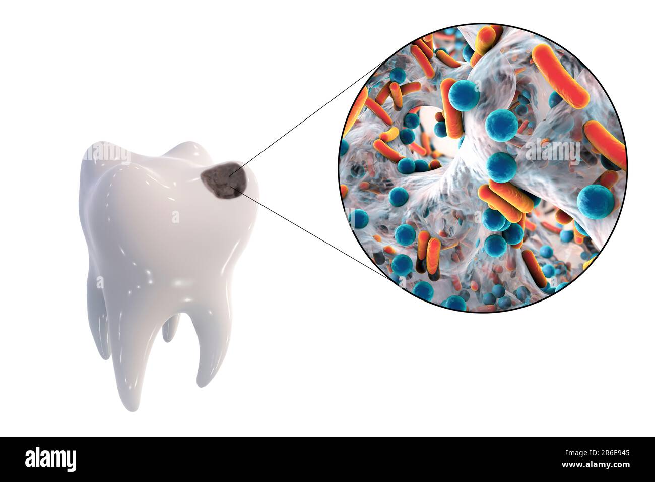 Carie dentali. Illustrazione di un dente con cavità e vista ravvicinata dei batteri che causano la formazione di carie. Foto Stock