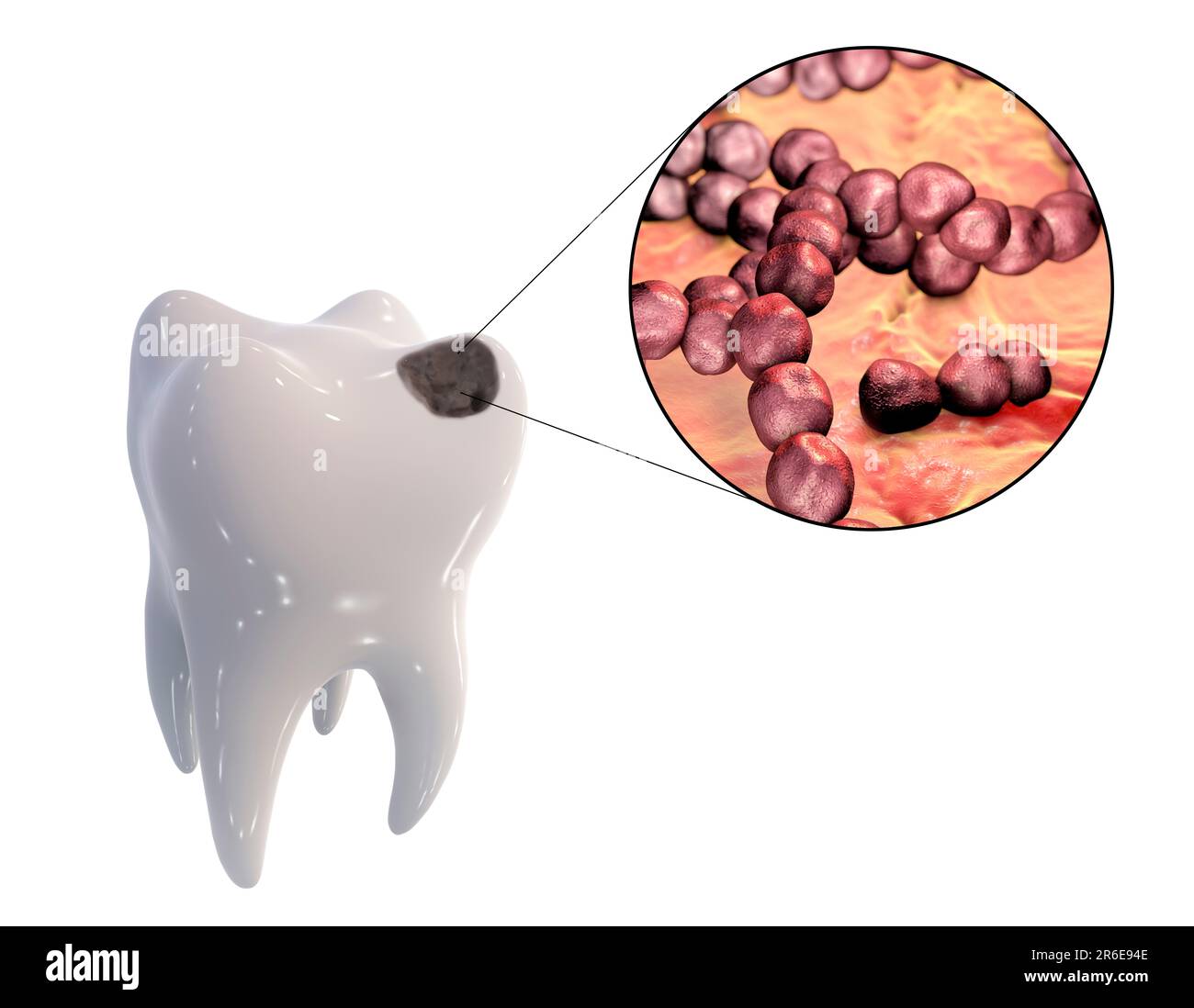 Carie dentali. Illustrazione di un dente con cavità e vista ravvicinata dei batteri che causano la formazione di carie. Foto Stock