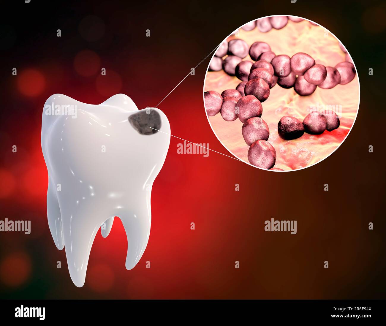 Carie dentali. Illustrazione di un dente con cavità e vista ravvicinata dei batteri che causano la formazione di carie. Foto Stock