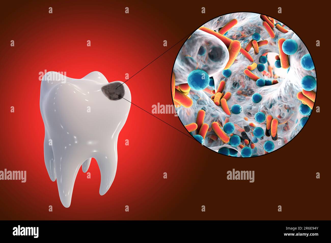 Carie dentali. Illustrazione di un dente con cavità e vista ravvicinata dei batteri che causano la formazione di carie. Foto Stock