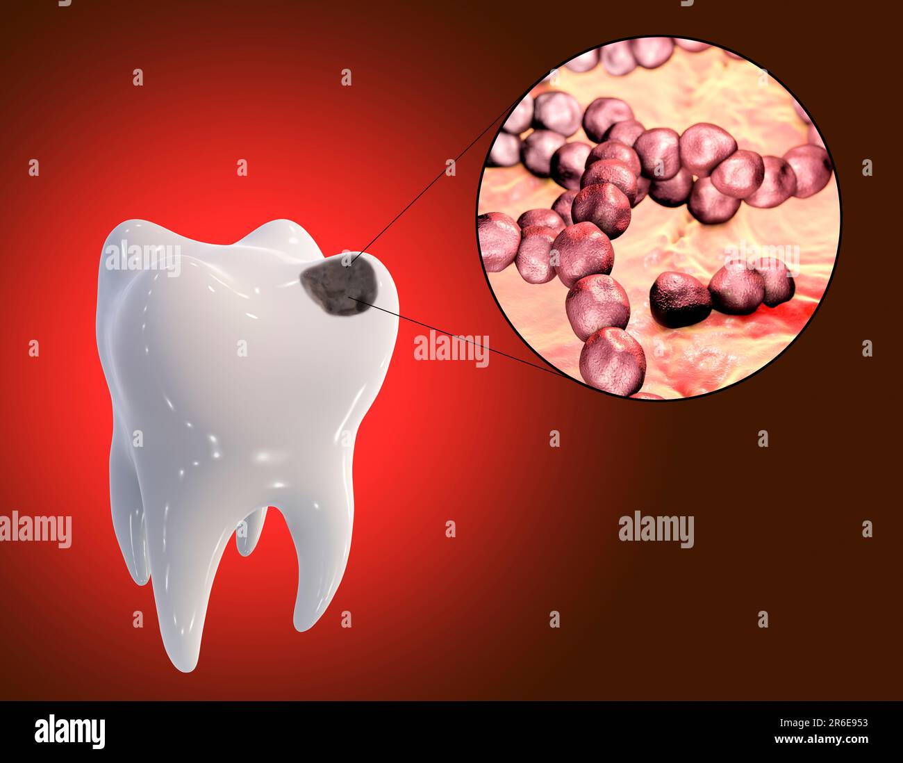 Carie dentali. Illustrazione di un dente con cavità e vista ravvicinata dei batteri che causano la formazione di carie. Foto Stock