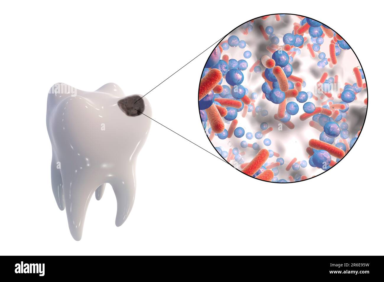 Carie dentali. Illustrazione di un dente con cavità e vista ravvicinata dei batteri che causano la formazione di carie. Foto Stock