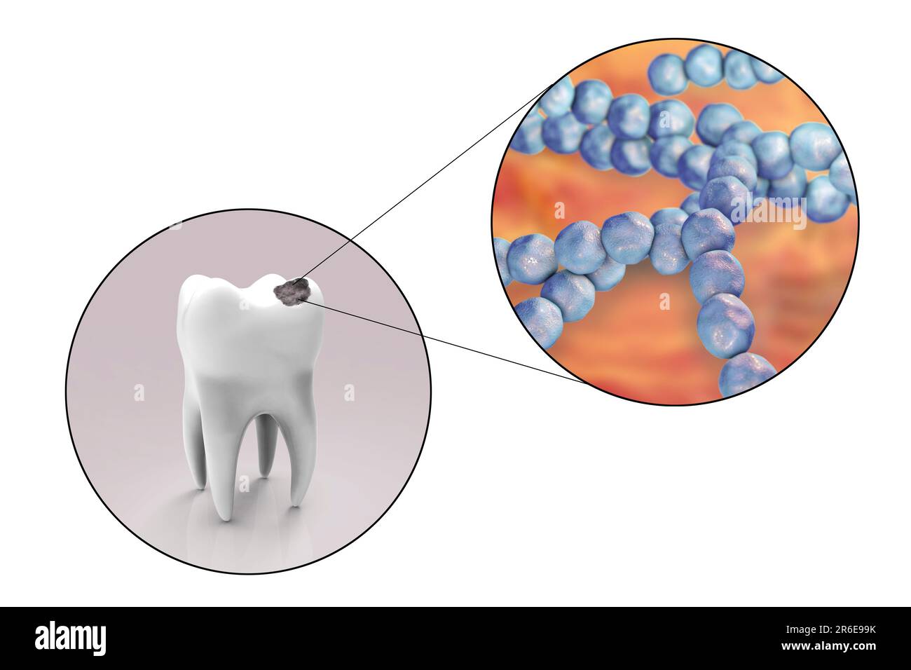 Carie dentali. Illustrazione di un dente con cavità e vista ravvicinata dei batteri che causano la formazione di carie. Foto Stock