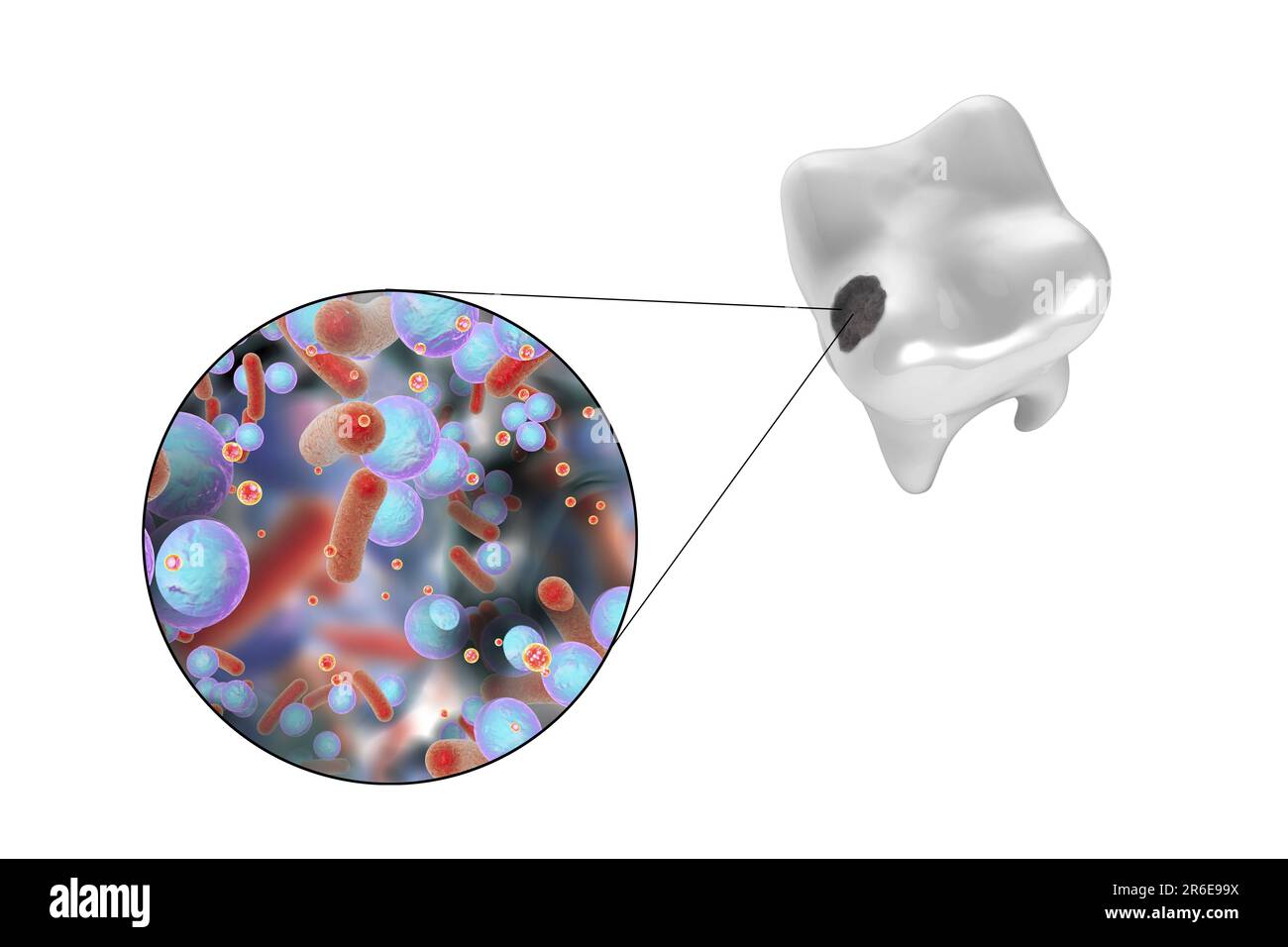 Carie dentali. Illustrazione di un dente con cavità e vista ravvicinata dei batteri che causano la formazione di carie. Foto Stock