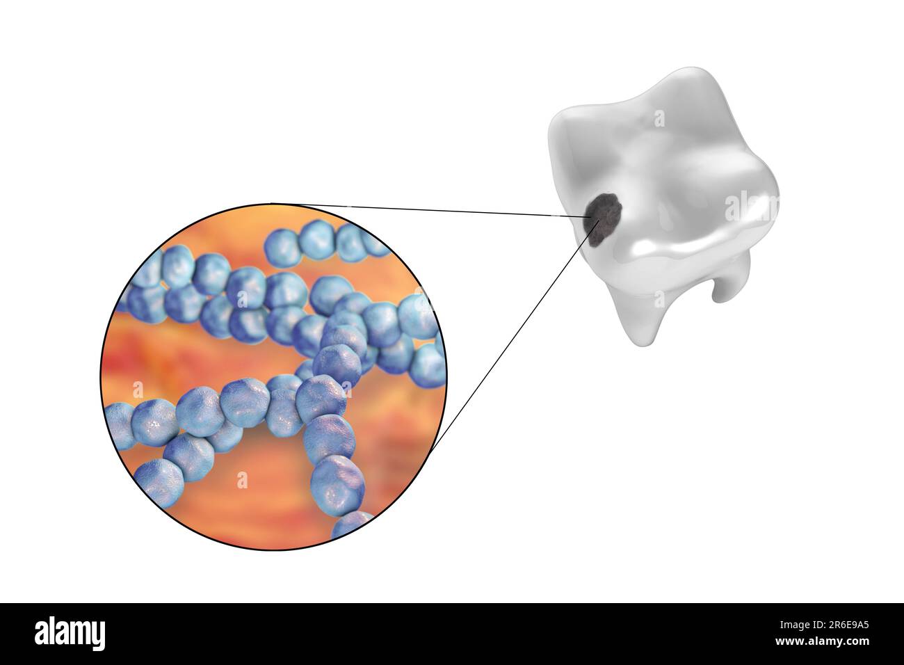 Carie dentali. Illustrazione di un dente con cavità e vista ravvicinata dei batteri che causano la formazione di carie. Foto Stock