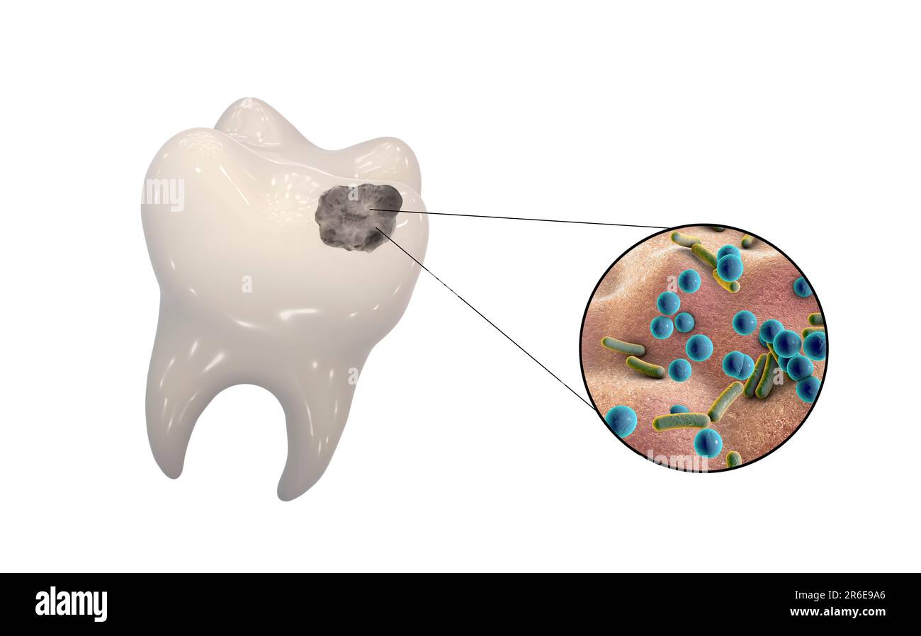 Carie dentali. Illustrazione di un dente con cavità e vista ravvicinata dei batteri che causano la formazione di carie. Foto Stock