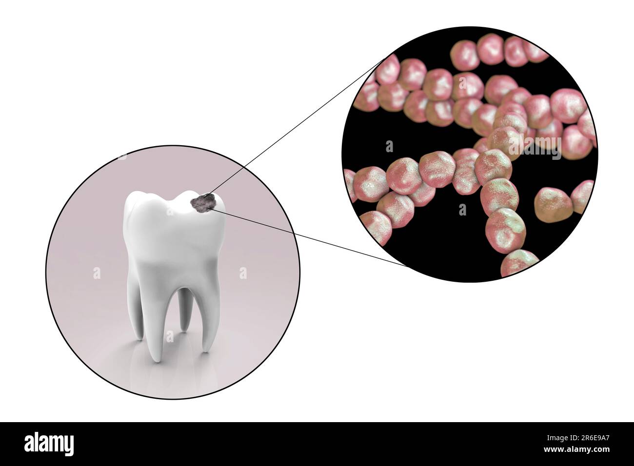 Carie dentali. Illustrazione di un dente con cavità e vista ravvicinata dei batteri che causano la formazione di carie. Foto Stock