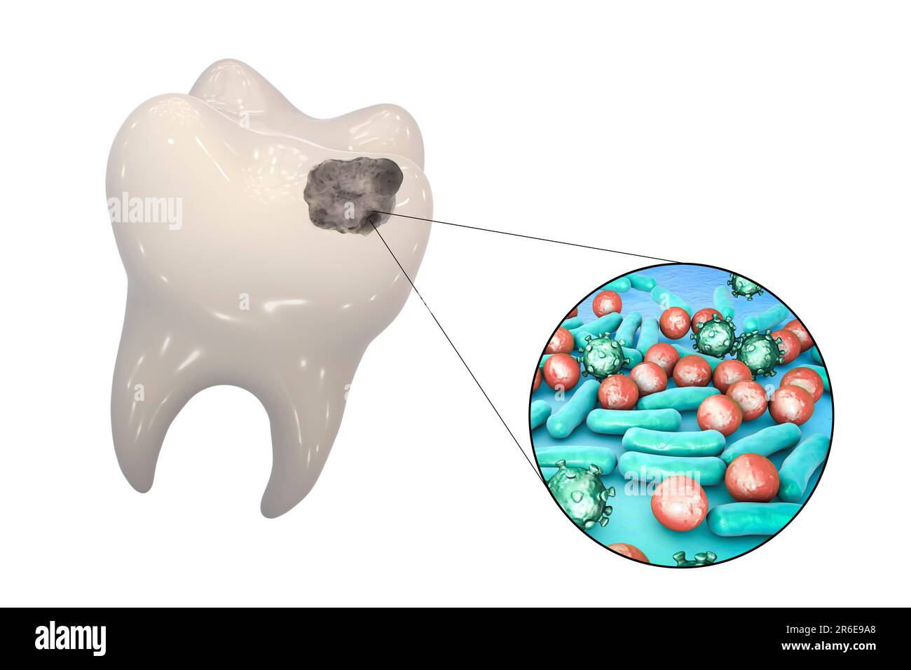 Carie dentali. Illustrazione di un dente con cavità e vista ravvicinata dei batteri che causano la formazione di carie. Foto Stock