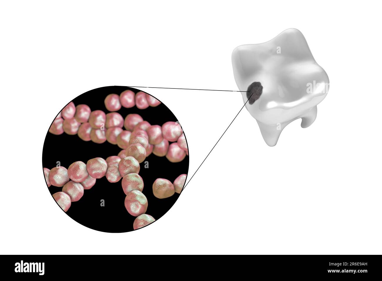 Carie dentali. Illustrazione di un dente con cavità e vista ravvicinata dei batteri che causano la formazione di carie. Foto Stock