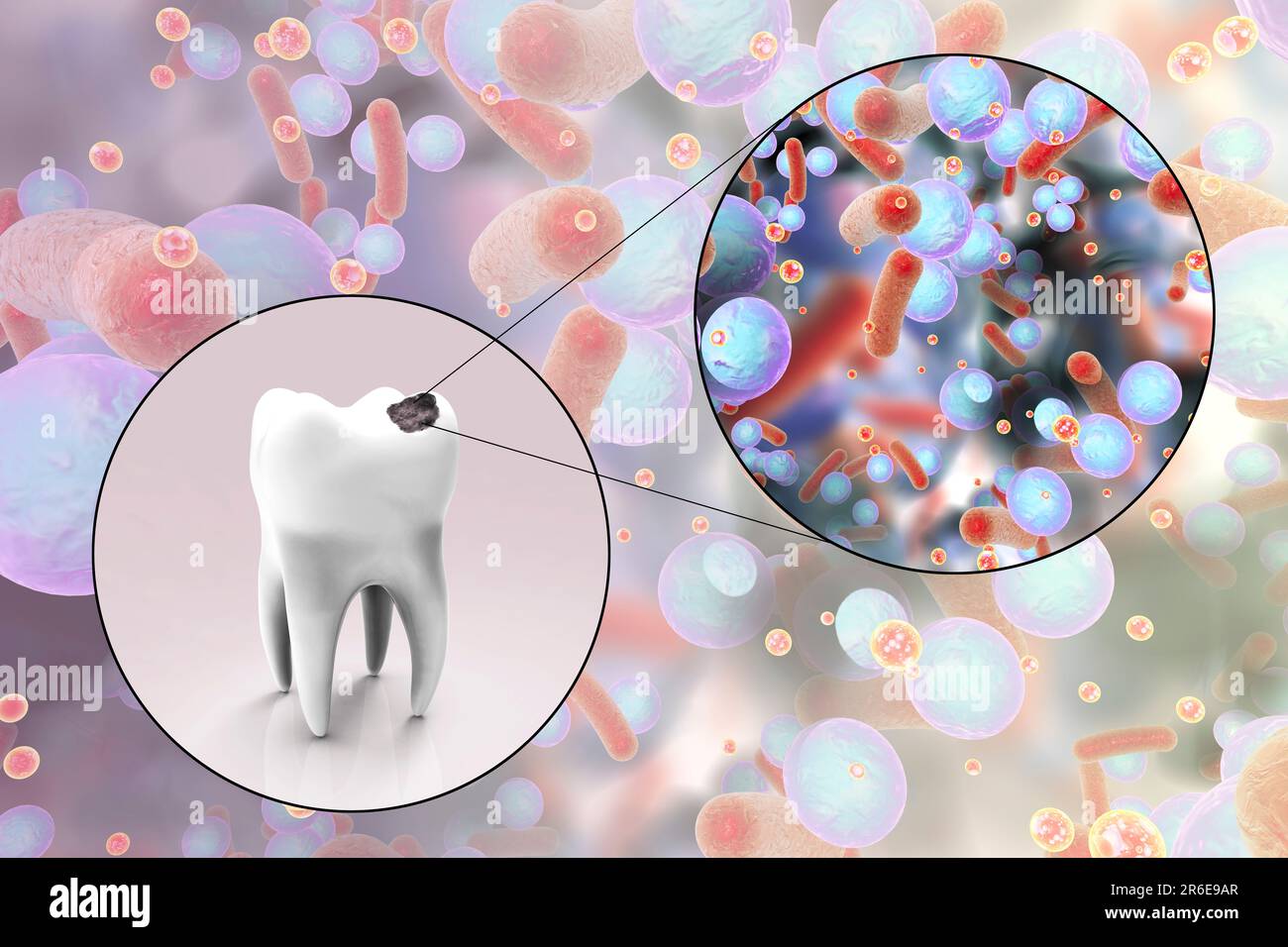 Carie dentali. Illustrazione di un dente con cavità e vista ravvicinata dei batteri che causano la formazione di carie. Foto Stock