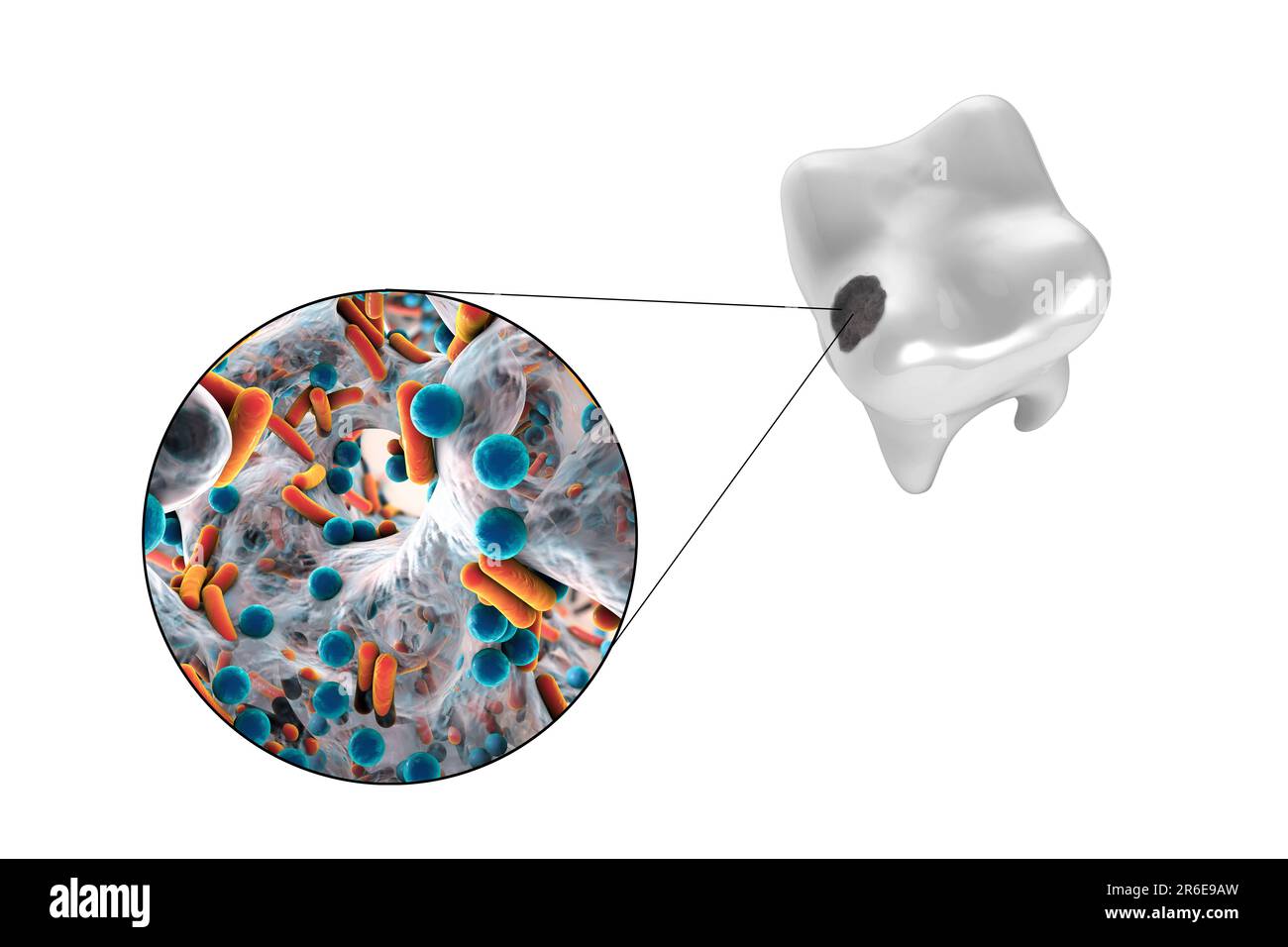 Carie dentali. Illustrazione di un dente con cavità e vista ravvicinata dei batteri che causano la formazione di carie. Foto Stock