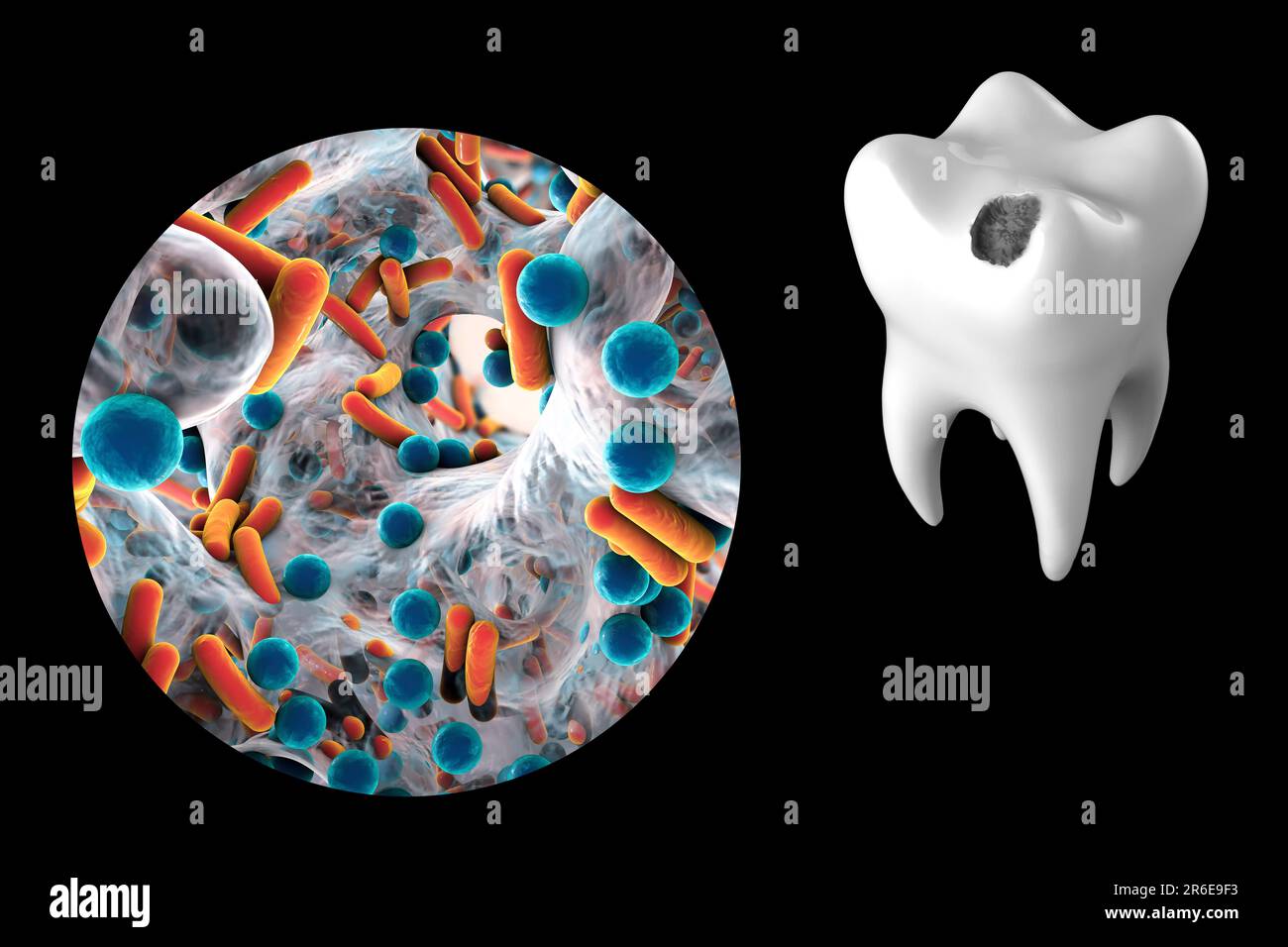 Carie dentali. Illustrazione di un dente con cavità e vista ravvicinata dei batteri che causano la formazione di carie. Foto Stock