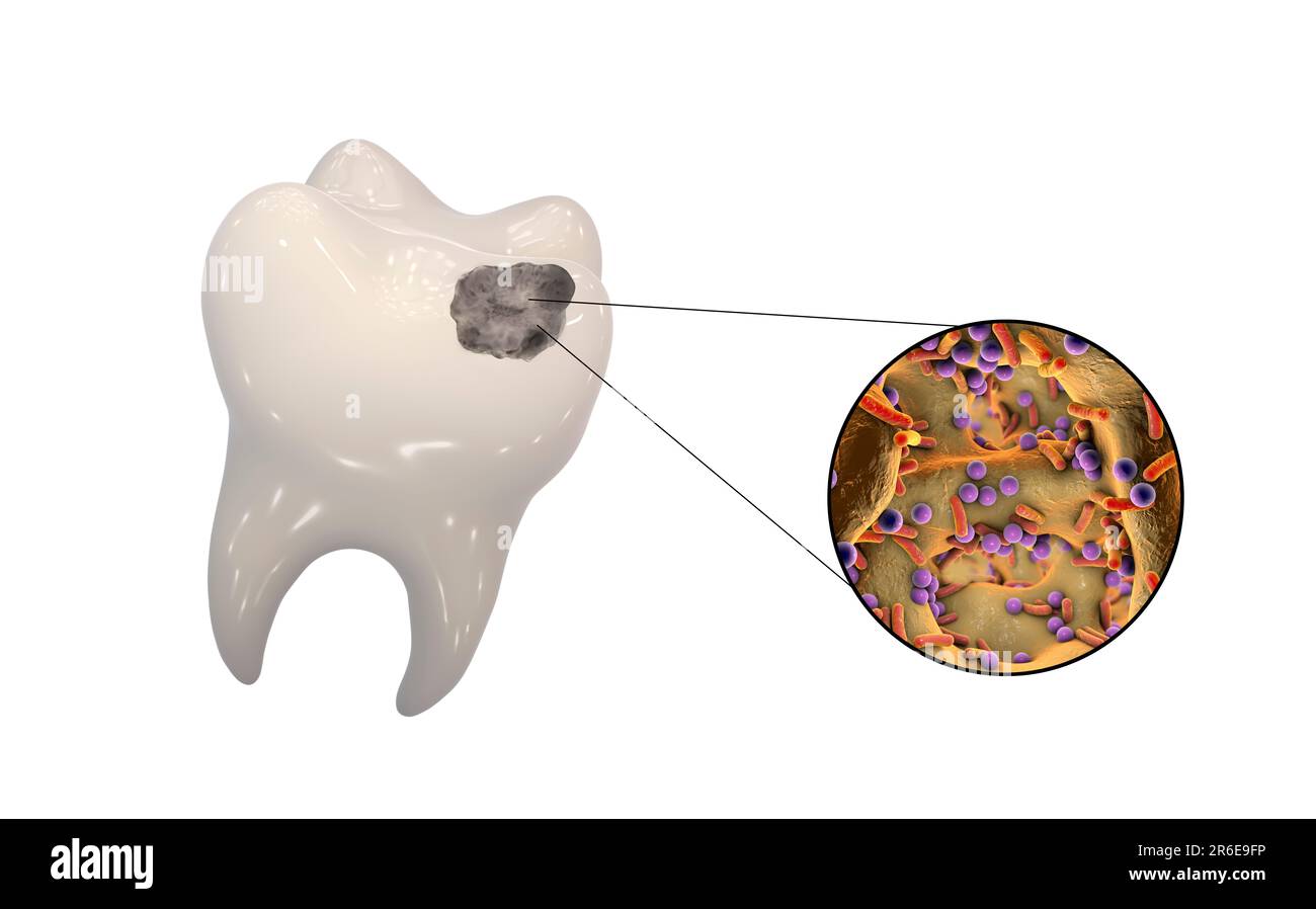 Carie dentali. Illustrazione di un dente con cavità e vista ravvicinata dei batteri che causano la formazione di carie. Foto Stock