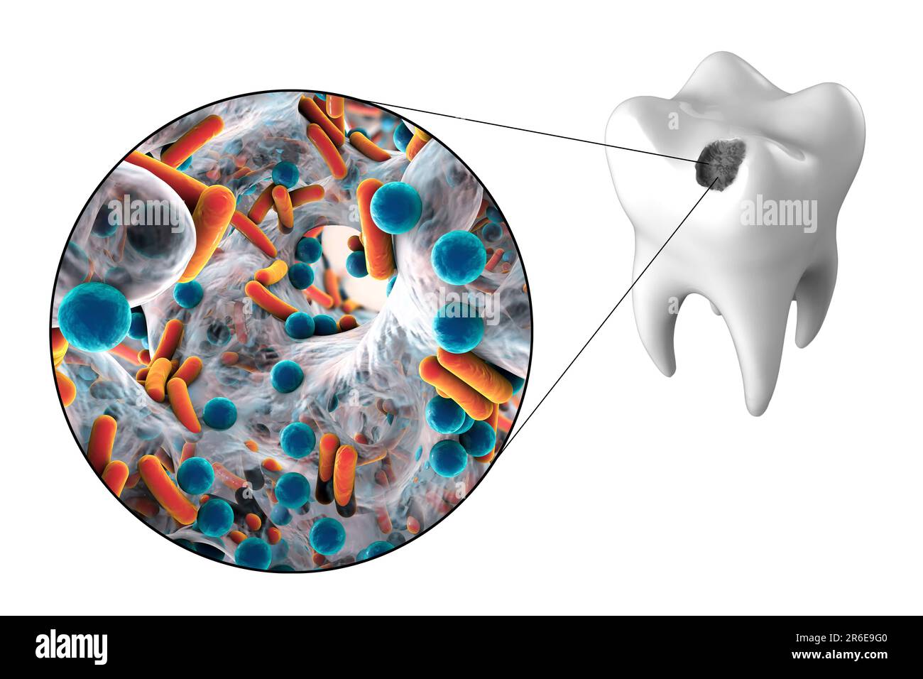 Carie dentali. Illustrazione di un dente con cavità e vista ravvicinata dei batteri che causano la formazione di carie. Foto Stock