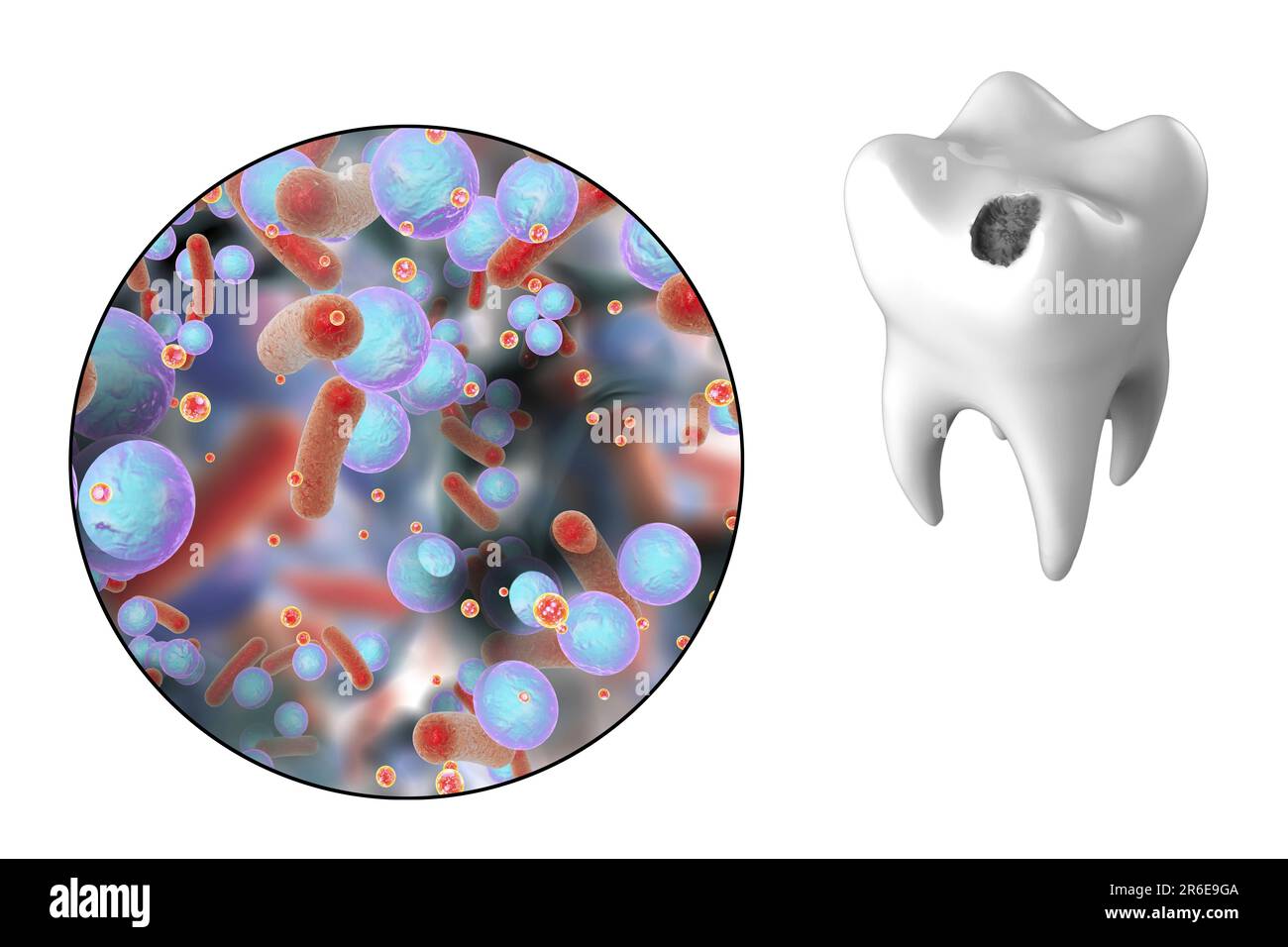 Carie dentali. Illustrazione di un dente con cavità e vista ravvicinata dei batteri che causano la formazione di carie. Foto Stock