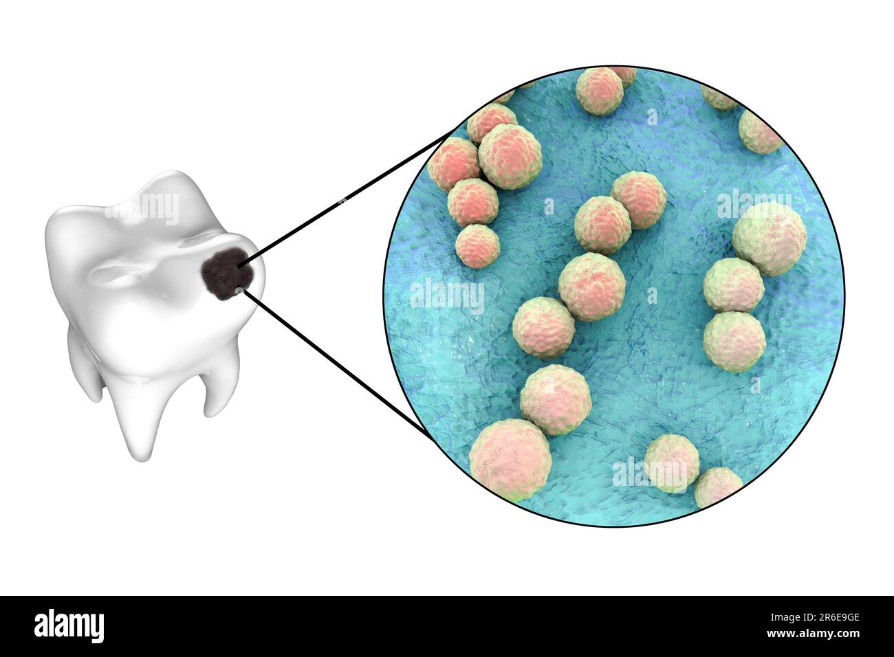 Carie dentali. Illustrazione di un dente con cavità e vista ravvicinata dei batteri che causano la formazione di carie. Foto Stock