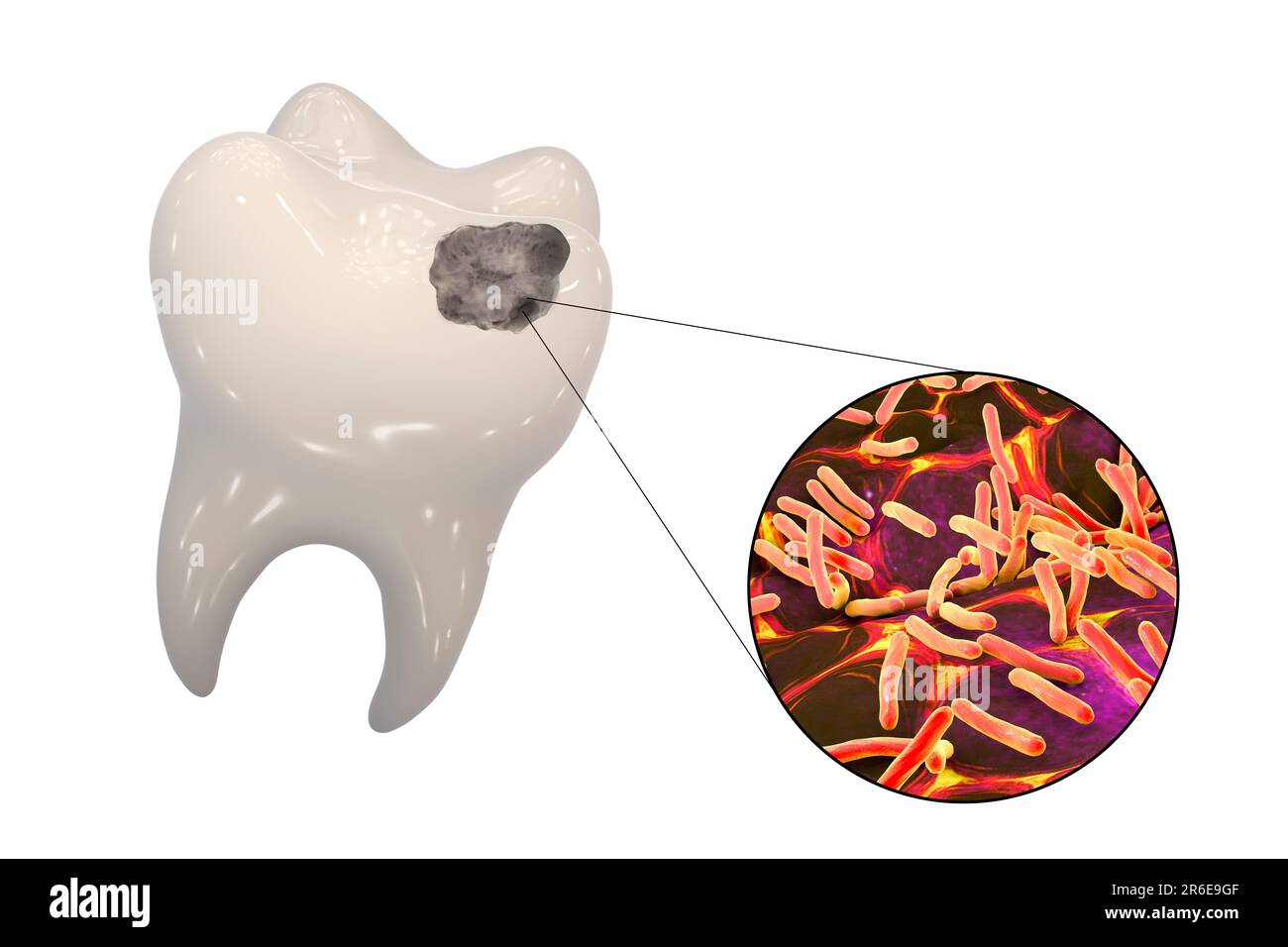 Carie dentali. Illustrazione di un dente con cavità e vista ravvicinata dei batteri che causano la formazione di carie. Foto Stock
