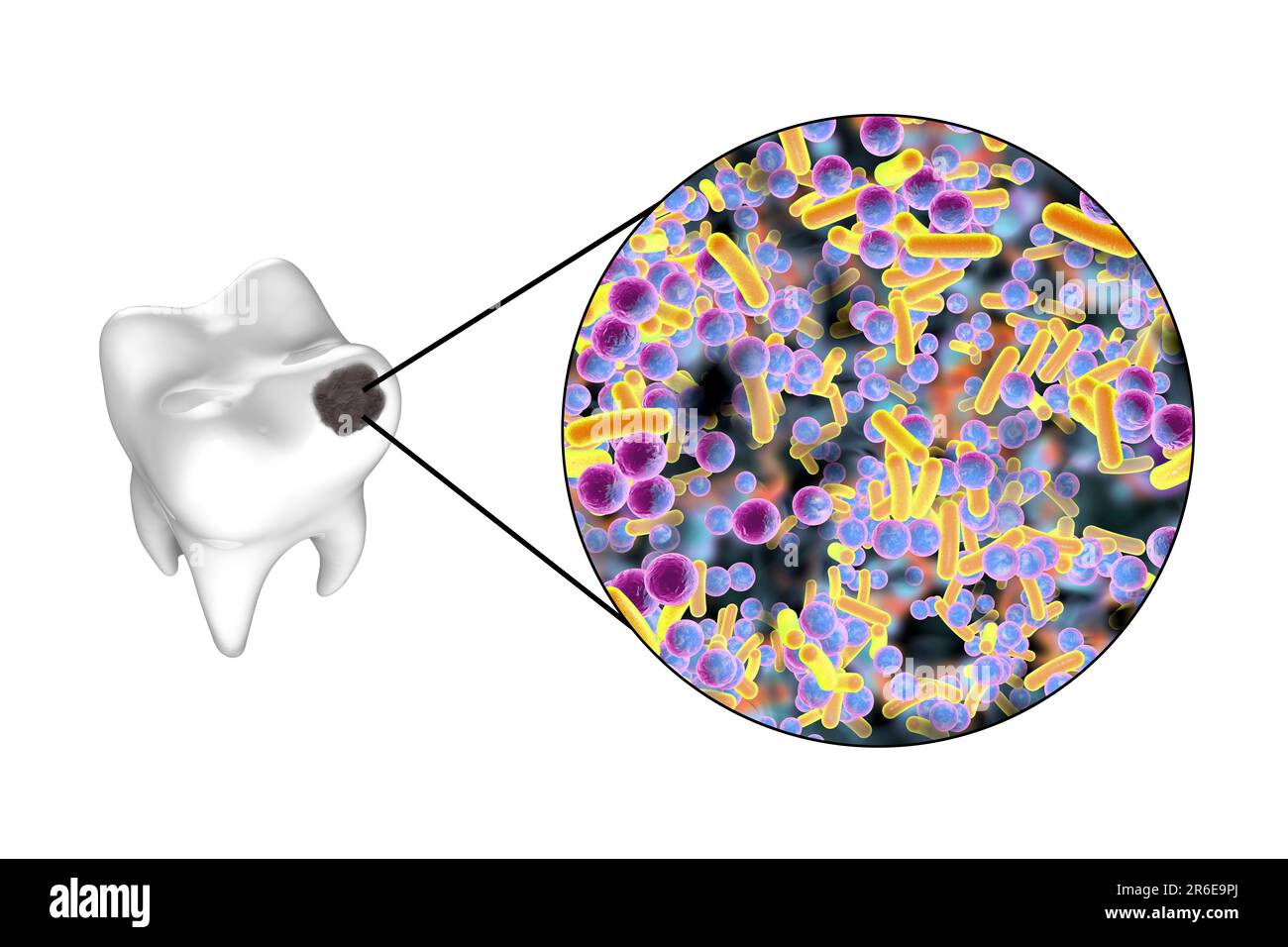 Carie dentali. Illustrazione di un dente con cavità e vista ravvicinata dei batteri che causano la formazione di carie. Foto Stock