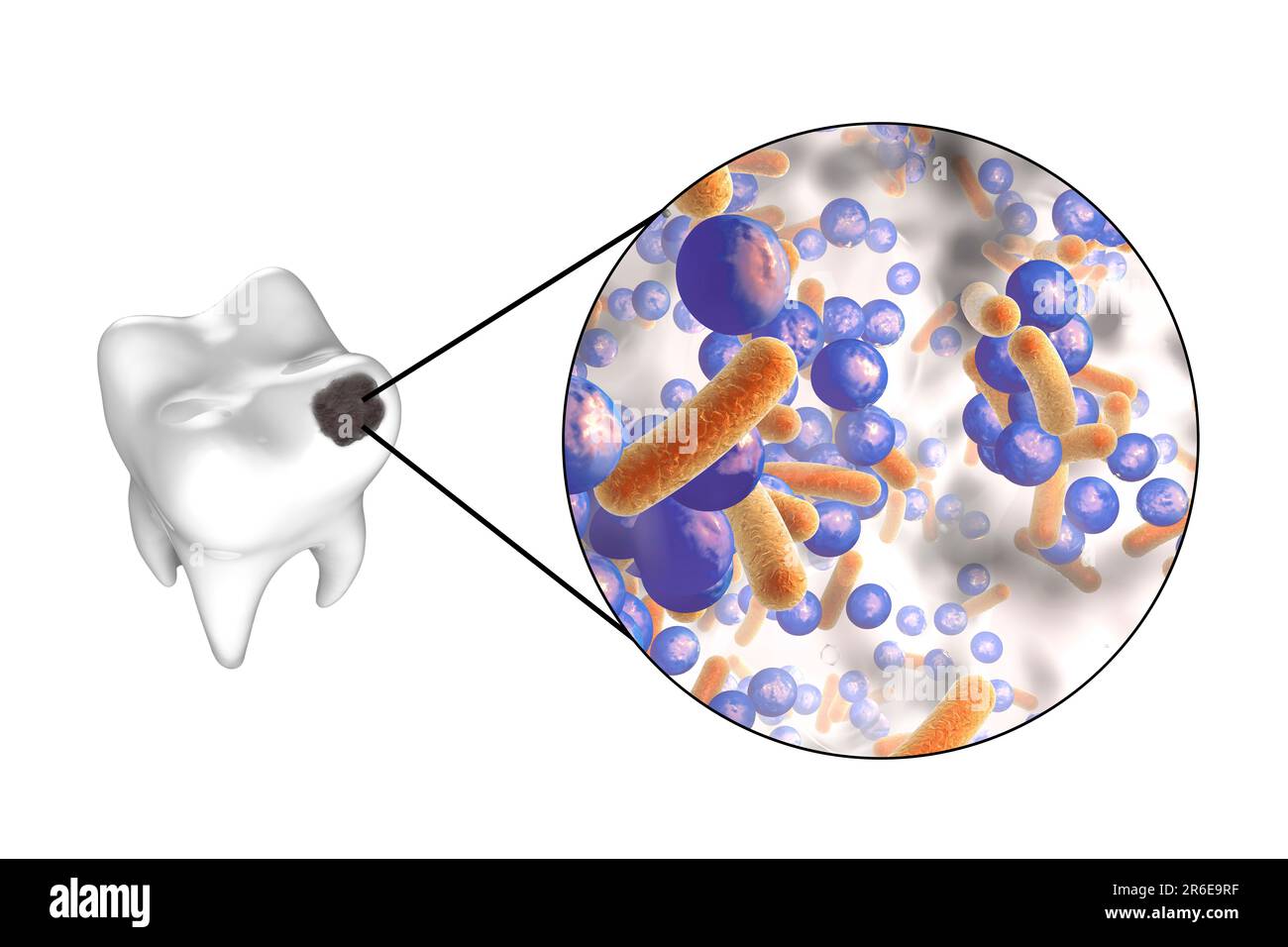 Carie dentali. Illustrazione di un dente con cavità e vista ravvicinata dei batteri che causano la formazione di carie. Foto Stock