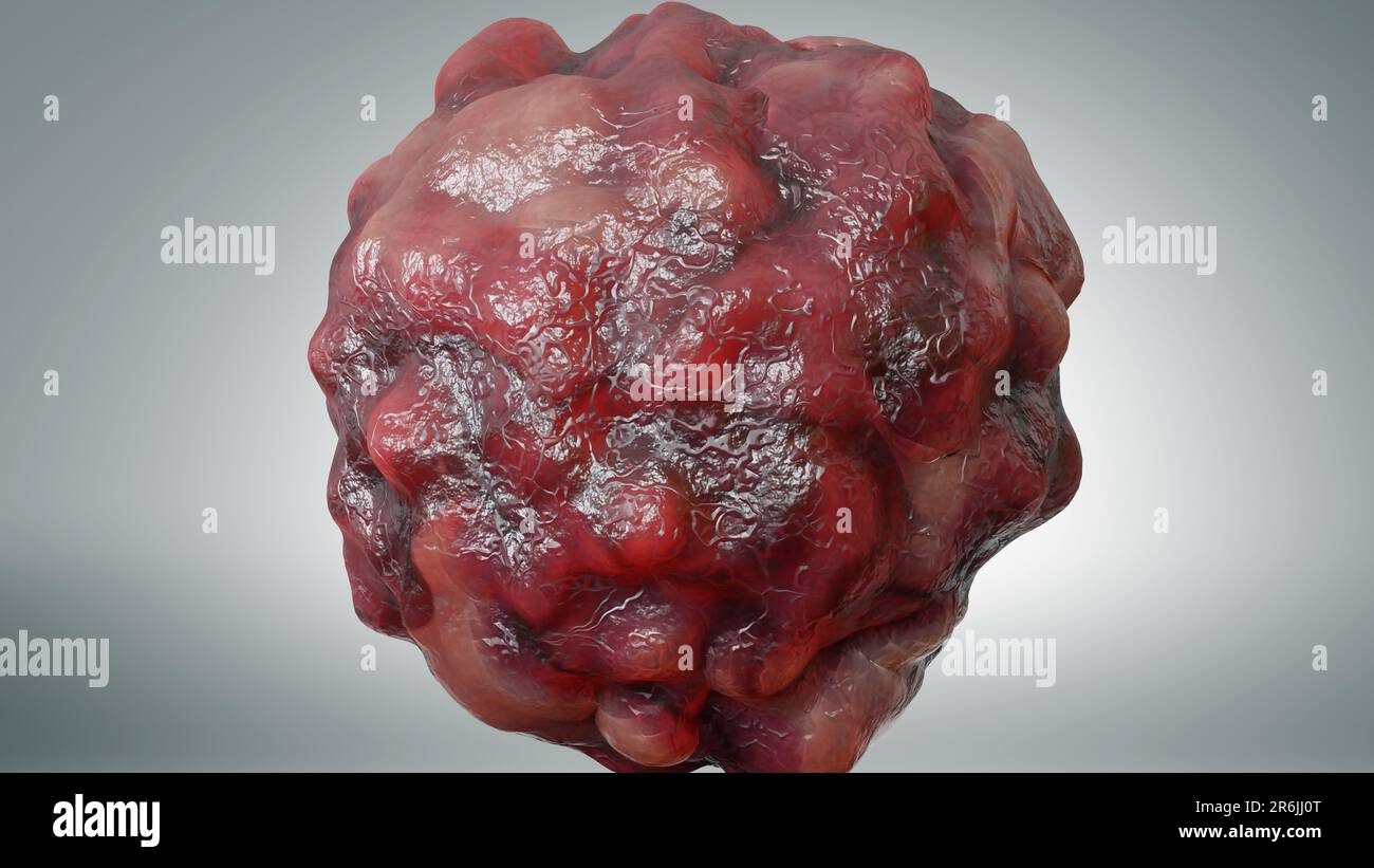 Crescita delle cellule tumorali incontrollabile sui tessuti, cellule di infezione tumorale e diffusione, infiammazione invasiva e metastasi cancerose. riproduci Foto Stock