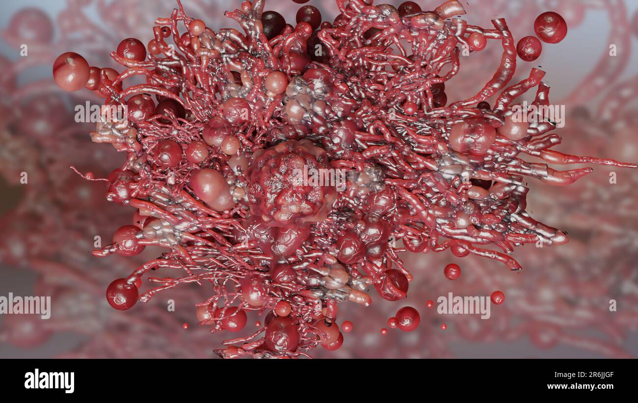 Crescita delle cellule tumorali incontrollabile sui tessuti, cellule di infezione tumorale e diffusione, infiammazione invasiva e metastasi cancerose. riproduci Foto Stock