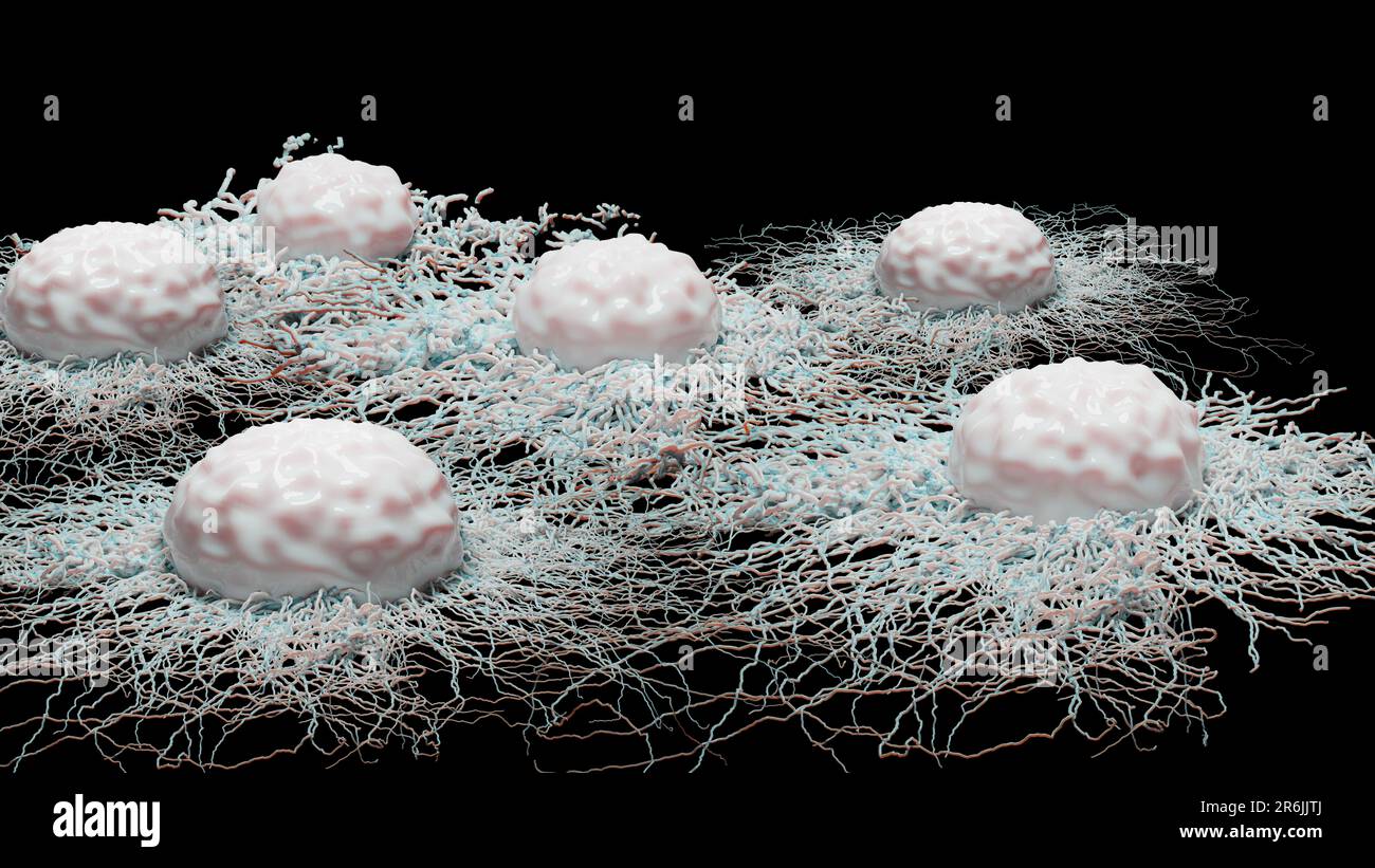 Crescita delle cellule tumorali incontrollabile sui tessuti, cellule di infezione tumorale e diffusione, infiammazione invasiva e metastasi cancerose. riproduci Foto Stock