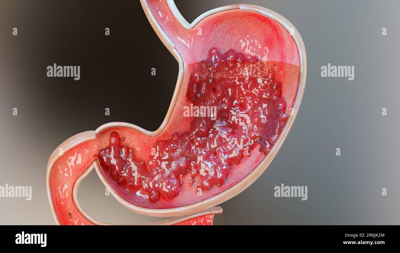 Cancro allo stomaco. Stadi di crescita tumorale nell'apparato digerente, ulcera peptica, cellule di attacco del cancro. concetto di malattia gastrica. sintomi, maligno canceroso, Foto Stock