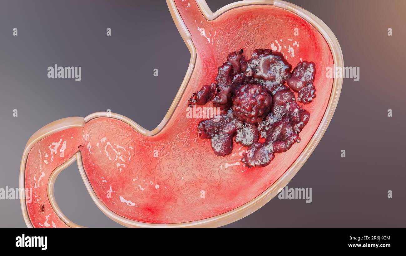 Cancro allo stomaco. Stadi di crescita tumorale nell'apparato digerente, ulcera peptica, cellule di attacco del cancro. concetto di malattia gastrica. sintomi, maligno canceroso, Foto Stock