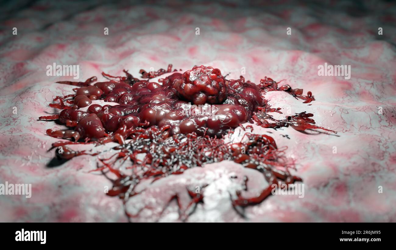 Crescita delle cellule tumorali incontrollabile sui tessuti, cellule di infezione tumorale e diffusione, infiammazione invasiva e metastasi cancerose. riproduci Foto Stock