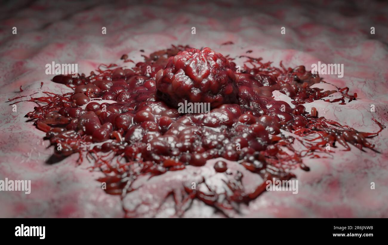 Crescita delle cellule tumorali incontrollabile sui tessuti, cellule di infezione tumorale e diffusione, infiammazione invasiva e metastasi cancerose. riproduci Foto Stock