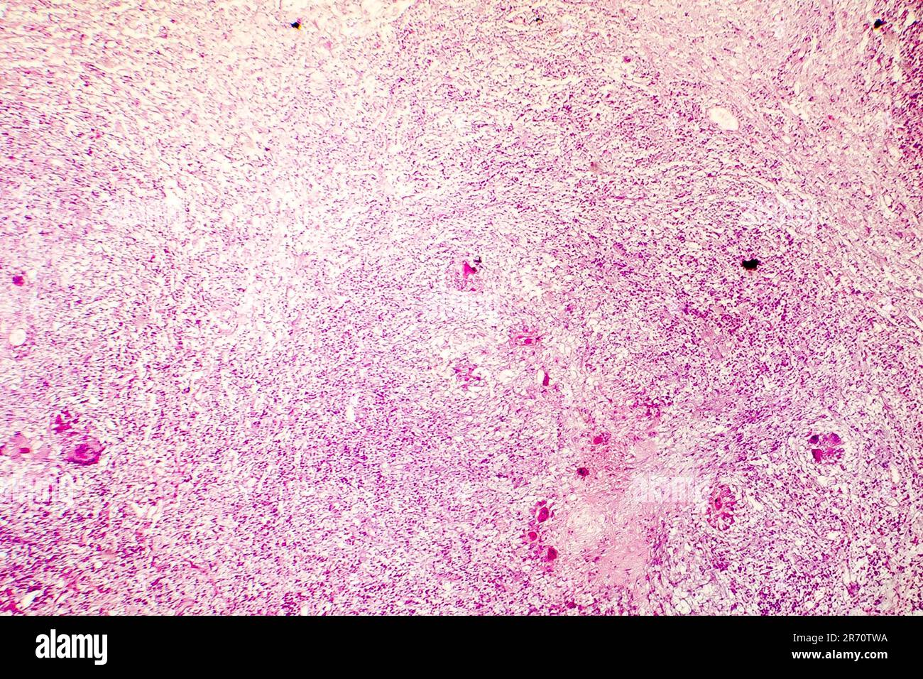 Necrosi liquefattiva del cervello umano, fotomicrografia leggera che mostra la perdita di contorni cellulari, accumulo di detriti cellulari, infiltratio macrofago Foto Stock