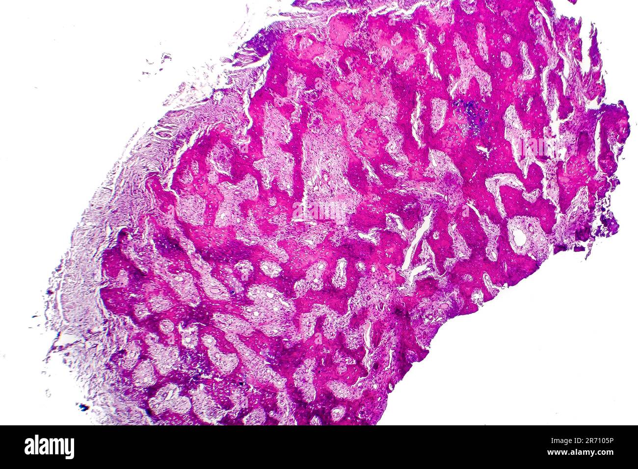 Istologia del callo, una pelle addensata prodotta come risultato di pressione, attrito ripetuto, micrografia leggera. Foto al microscopio Foto Stock