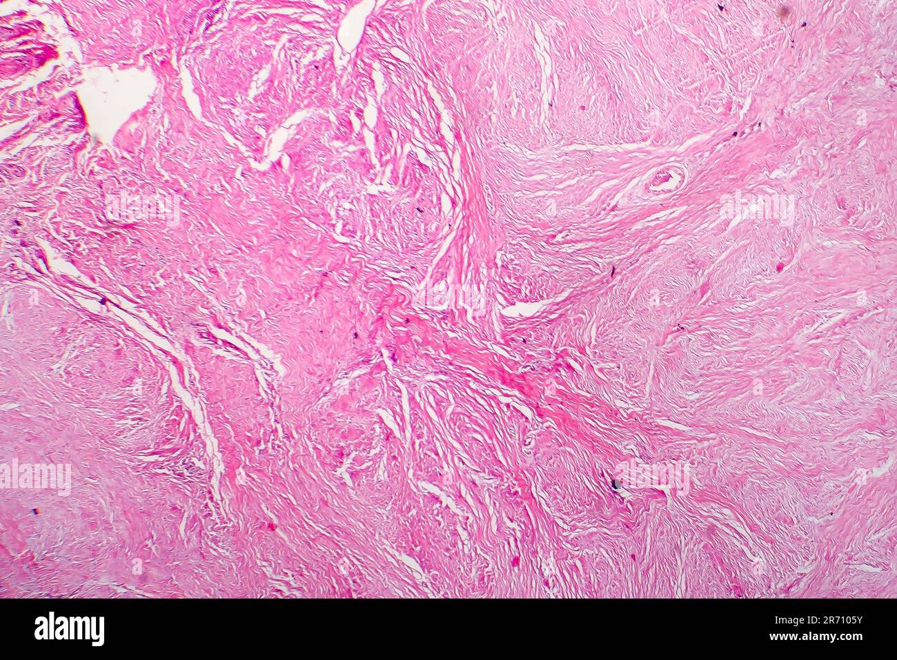 Micrografia leggera del tessuto cicatriziale. Foto al microscopio di una cicatrice formata durante la guarigione della ferita Foto Stock