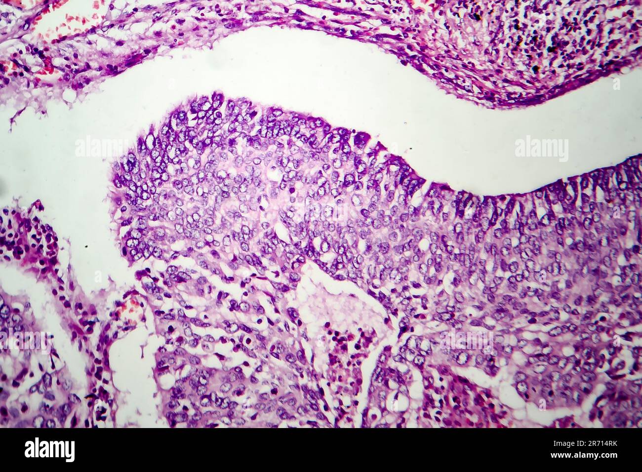 Adenocarcinoma polmonare, micrografia leggera, foto al microscopio Foto Stock