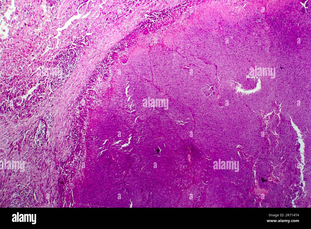 Caseazione di granuloma di tubercolosi umana, micrografia leggera, foto ...
