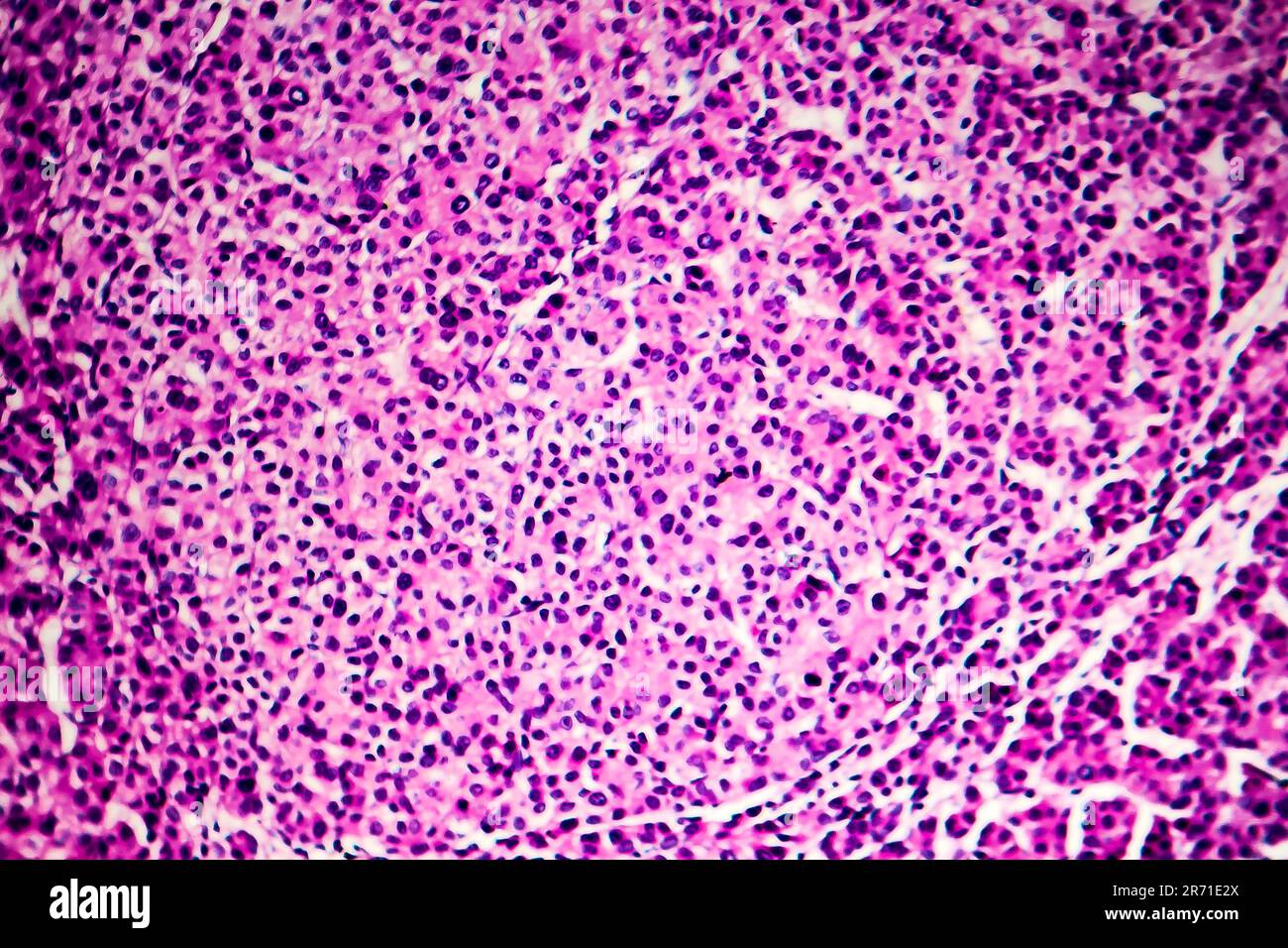 Carcinoma epatocellulare, cancro del fegato, micrografia leggera, foto al microscopio Foto Stock