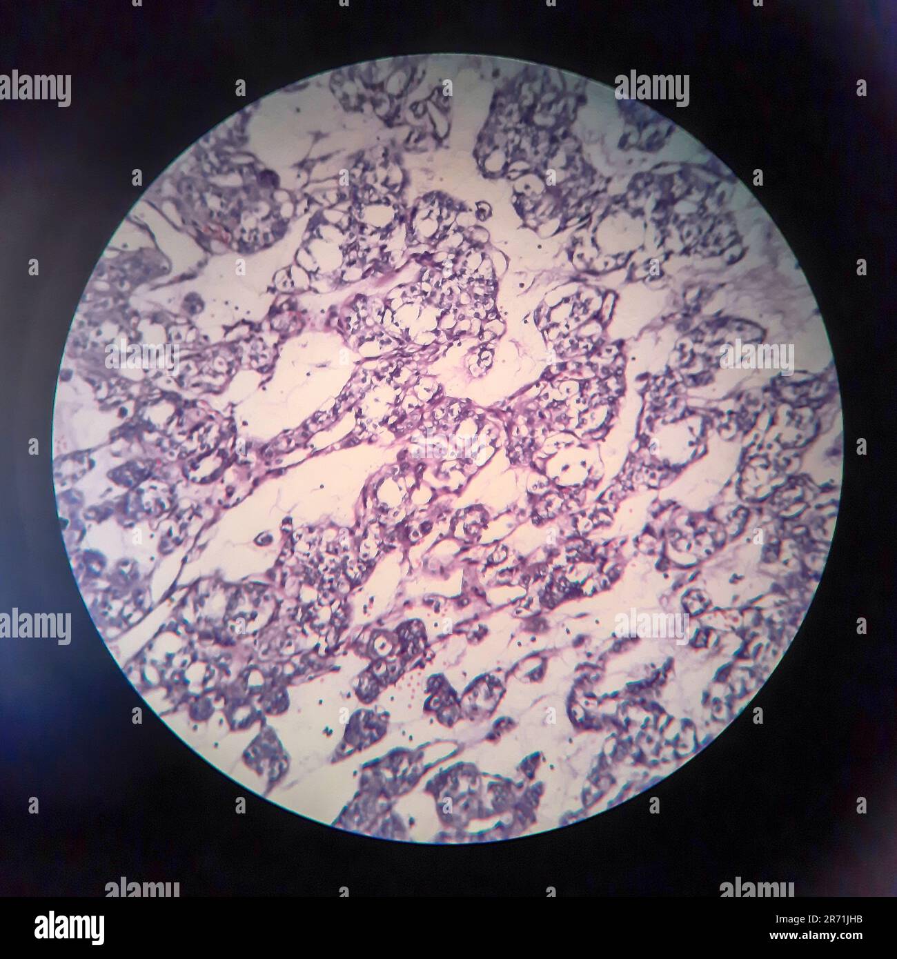 Carcinoma follicolare tiroideo, micrografia leggera, foto al microscopio Foto Stock