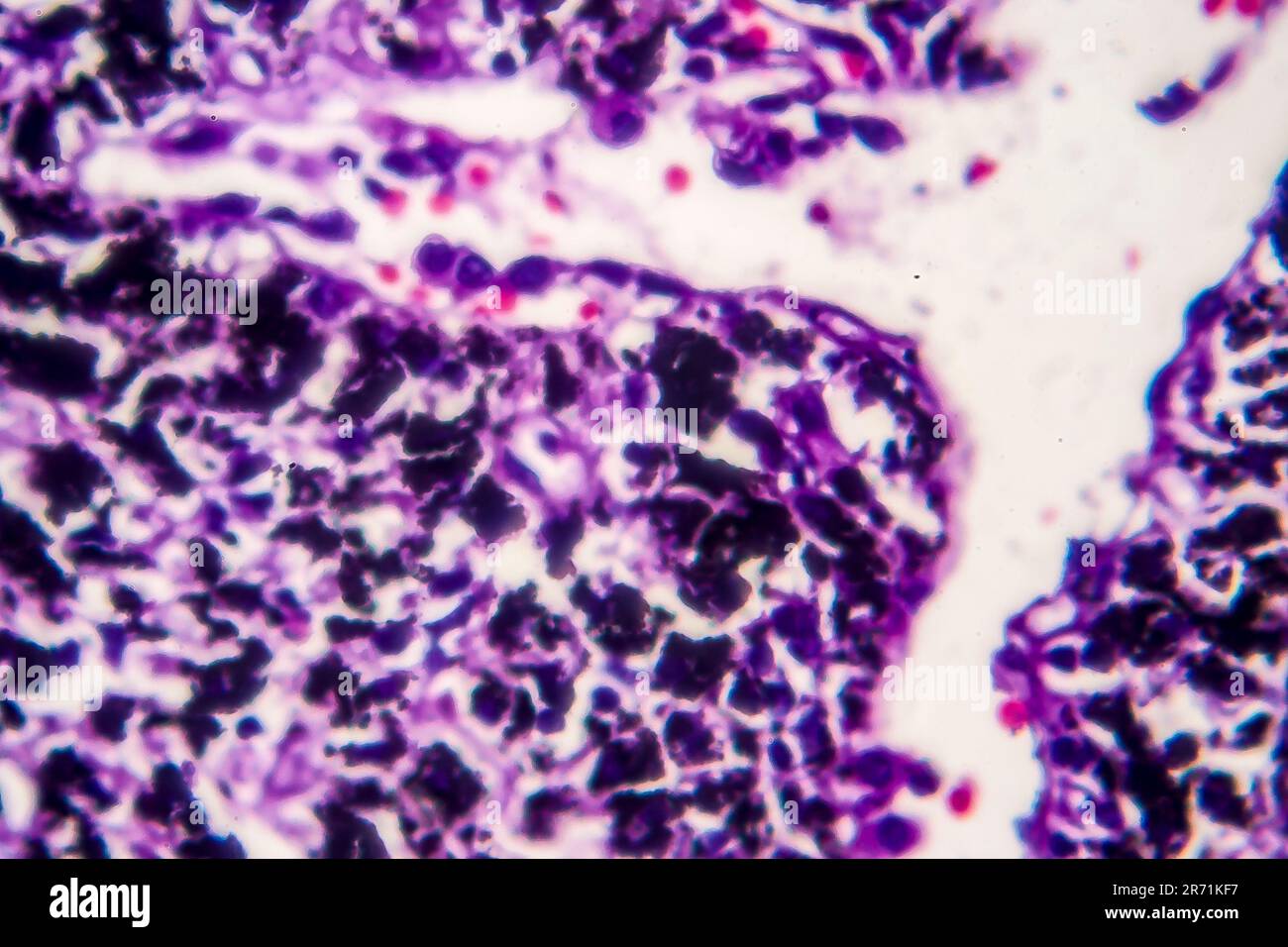 Istopatologia del polmone del fumatore. Micrografia leggera che mostra l'accumulo di particelle di carbonio nel tessuto polmonare Foto Stock