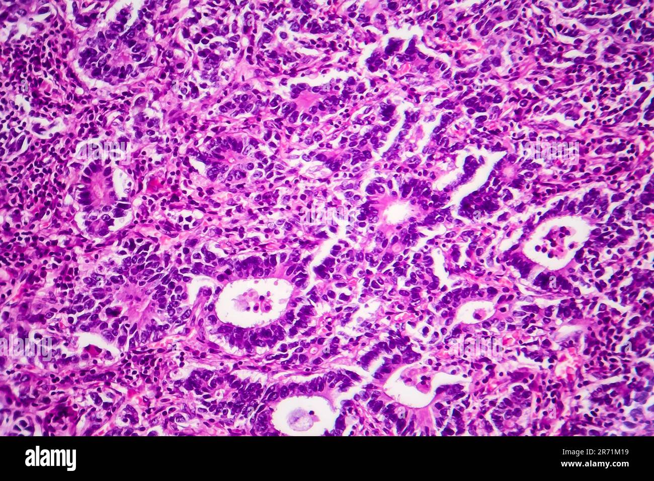 Adenocarcinoma gastrico, micrografia leggera, foto al microscopio Foto Stock