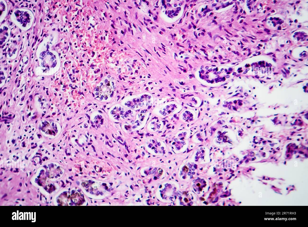 Piccola cirrosi nodulare, micrografia leggera, foto al microscopio Foto Stock