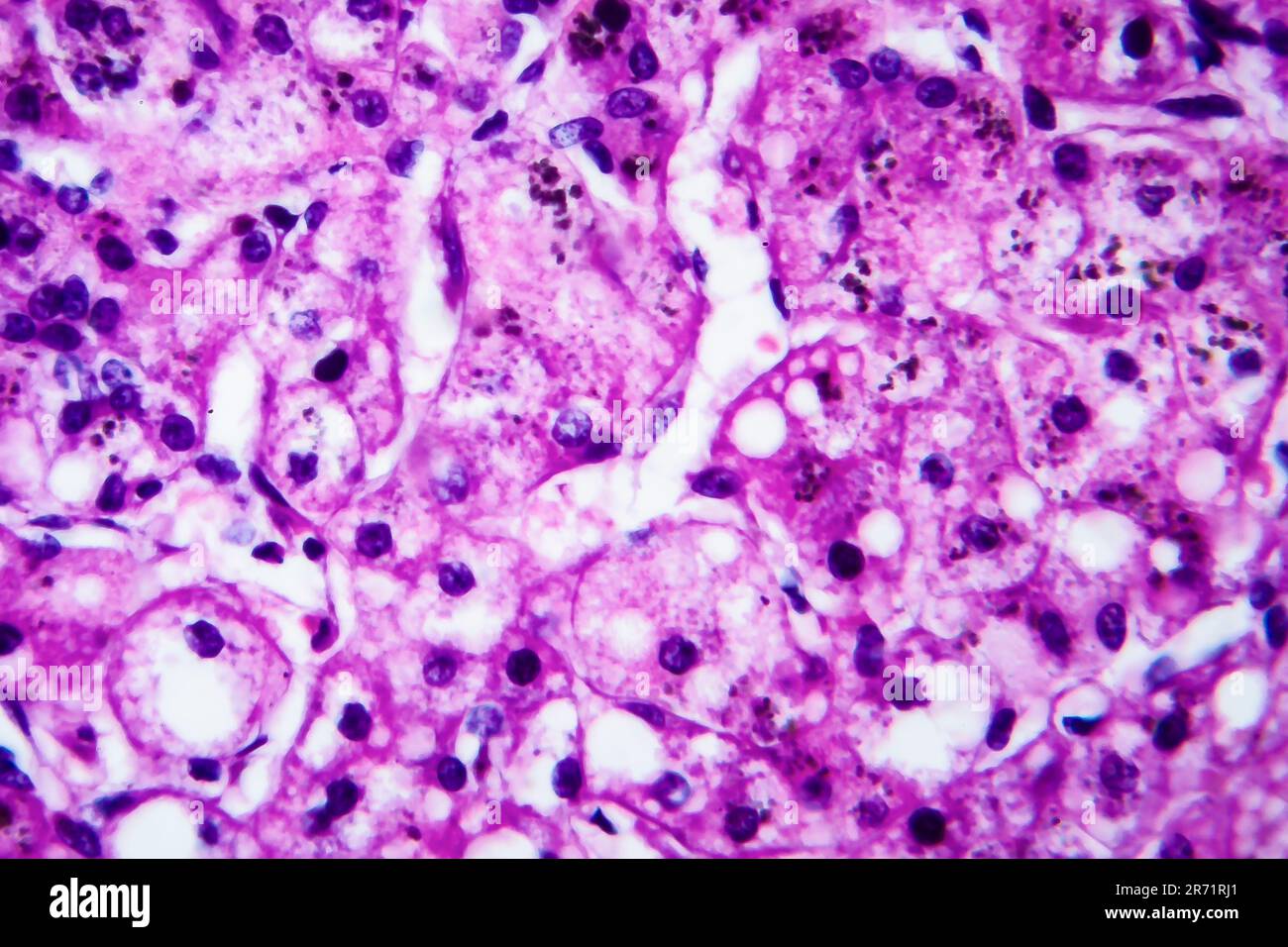 Piccola cirrosi nodulare, micrografia leggera, foto al microscopio. Ingrandimento elevato Foto Stock