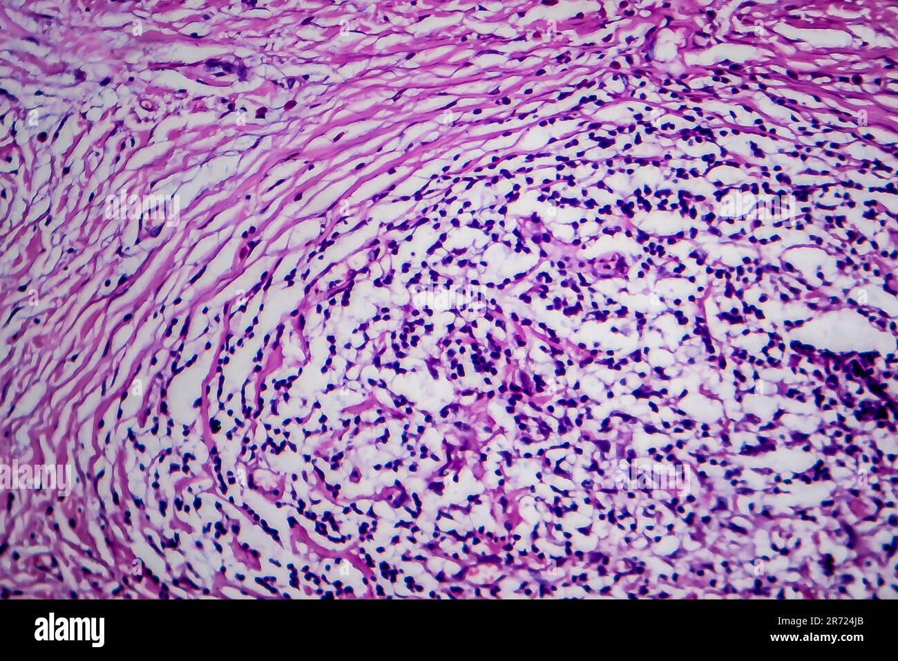 Linfoma di Hodgkin, micrografia leggera, foto al microscopio Foto stock ...