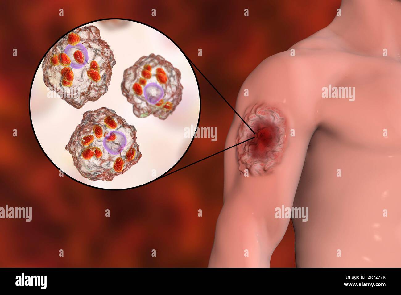 Ulcera cutanea nella leishmaniosi cutana e vista ravvicinata degli amastigoti di Leishmania trovati nei macrofagi, illustrazione. Questa condizione della pelle è causata da Foto Stock