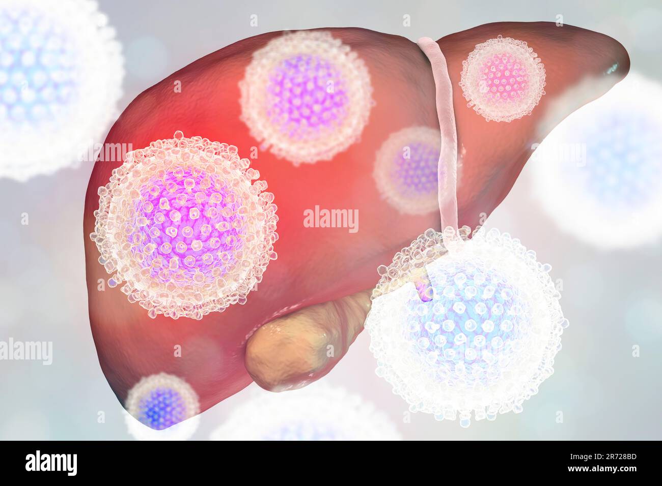 Fegato con epatite e vista ravvicinata di epatite C, virus di illustrazione. Foto Stock