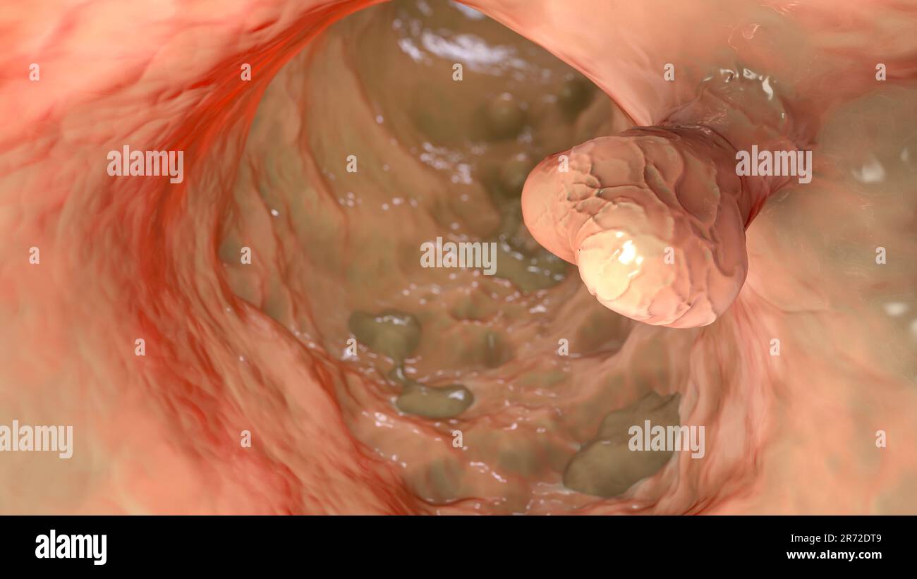 Computer illustrazione di polipi nell'intestino. I polipi sono piccole crescite benigne (non cancerose) che derivano dal rivestimento muco dell'intestino. P Foto Stock