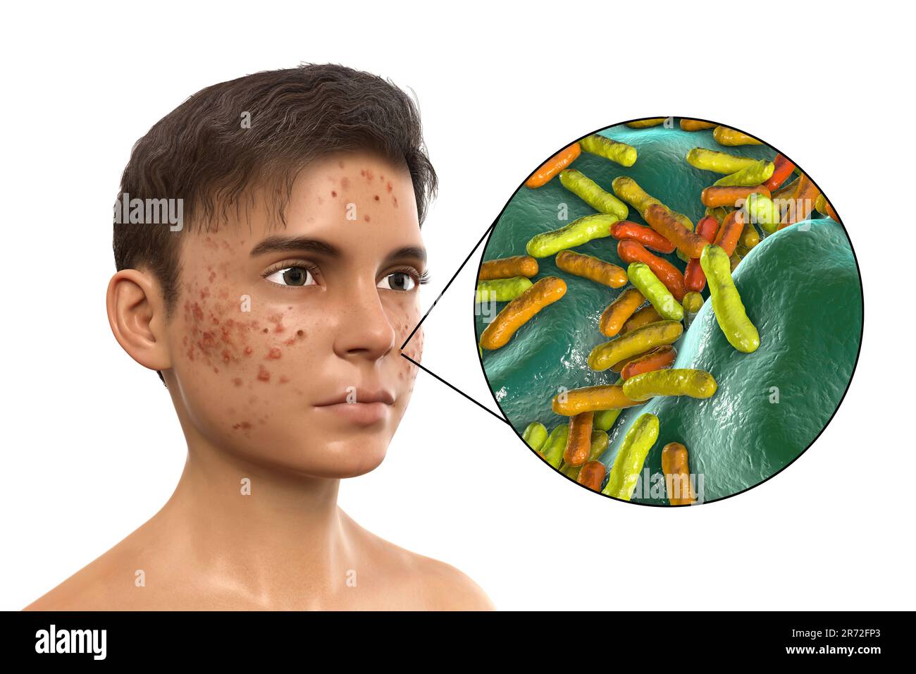 Vulgaris dell'acne sulla faccia del ragazzo dell'adolescenza e vista ravvicinata dei batteri che causano l'acne, illustrazione del calcolatore. L'acne è un nome generale dato ad un dis della pelle Foto Stock