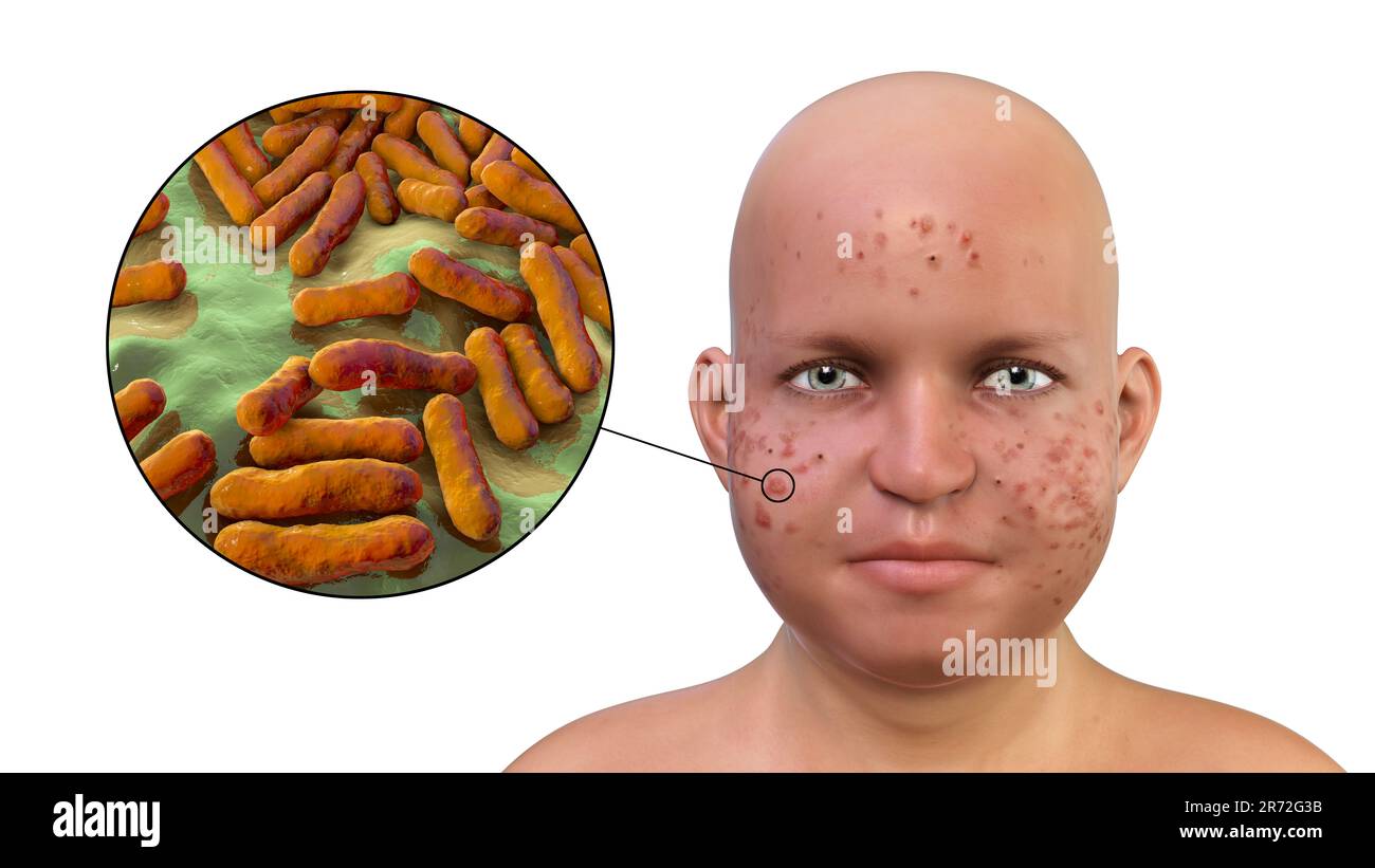 Vulgaris dell'acne sulla faccia del ragazzo dell'adolescenza in sovrappeso e vista ravvicinata dei batteri che causano l'acne, illustrazione del calcolatore. L'acne è un nome generale dato t Foto Stock